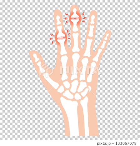 赫伯登節點和布沙爾節點 赫伯登節點和布沙爾節點 133067079