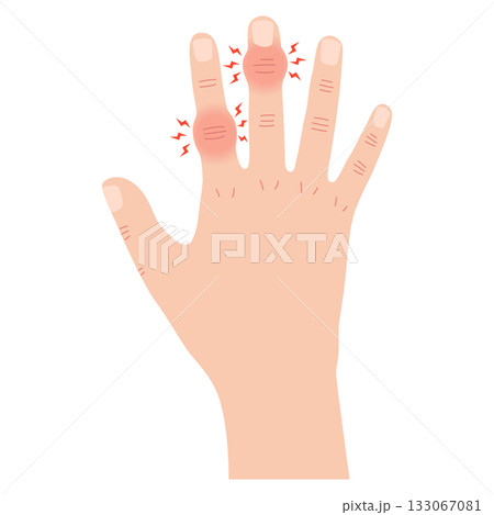 へバーデン結節とブシャール結節 133067081