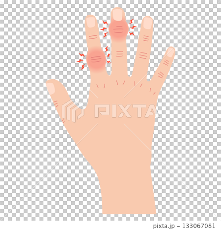 赫伯登節點和布沙爾節點 赫伯登節點和布沙爾節點 133067081