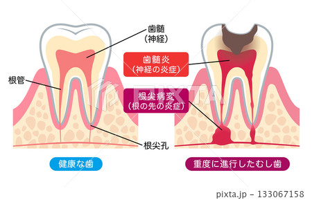 健康な歯と進行したむし歯　歯の内部構造 133067158