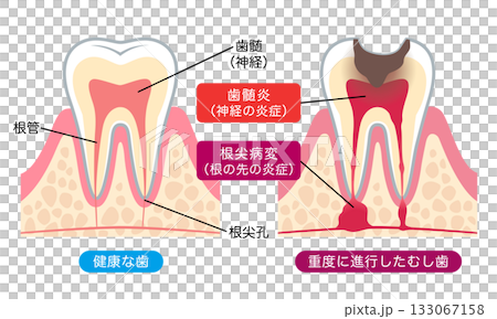 健康な歯と進行したむし歯　歯の内部構造 133067158