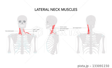 Lateral Neck Muscles - Group of muscles located on the sides of the neck, including the anterior, middle, and posterio 133091150