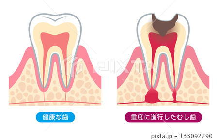 健康な歯と進行したむし歯　歯の内部構造 133092290