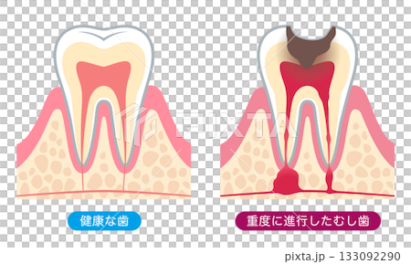 健康な歯と進行したむし歯　歯の内部構造 133092290