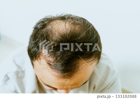 Early baldness, thinning hair, weak and fine hair, beauty concept, A closeup of a half-bald male head, hair transplant concept for hair loss 133102088