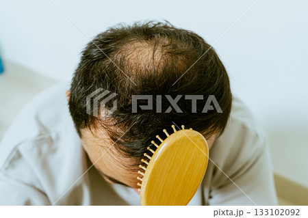 Early baldness, thinning hair, weak and fine hair, beauty concept, A closeup of a half-bald male head, hair transplant concept for hair loss Early baldness, thinning hair, weak and fine hair, beauty concept, A closeup of a half-bald male head, hair transplant concept for hair loss 133102092