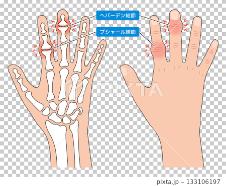 赫伯登節點和布沙爾節點 赫伯登節點和布沙爾節點 133106197