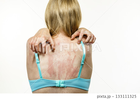 Woman scratching her itchy back with allergy rash Woman scratching her itchy back with allergy rash 133111325