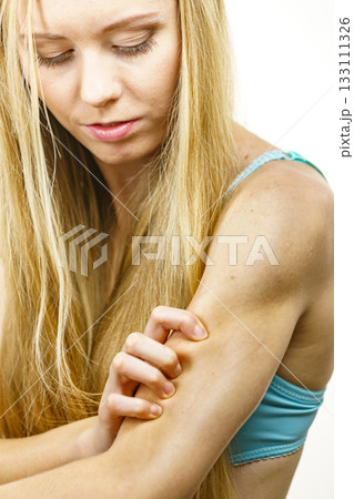 Woman scratching her itchy arm. Skin allergy. Woman scratching her itchy arm. Skin allergy. 133111326