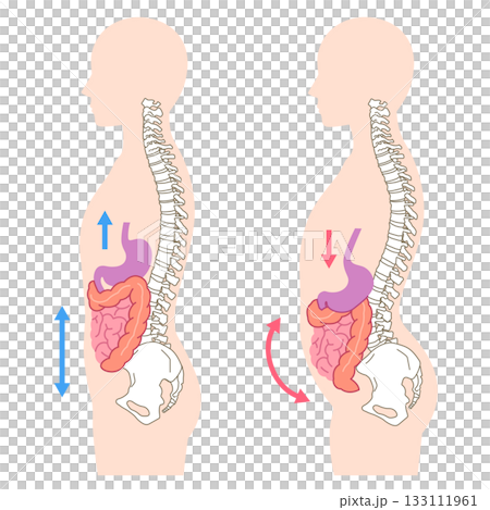 Visceroptosis: A condition in which the internal organs are lowered Visceroptosis: A condition in which the internal organs are lowered 133111961
