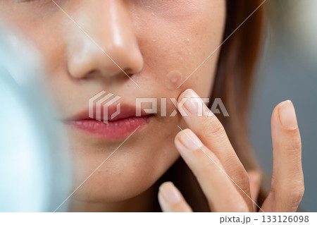 Skin Care Focus. Woman examining blemish on her face in the mirror. 133126098
