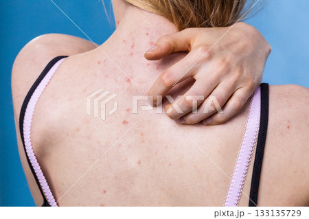 Woman with skin problem acne on back 133135729