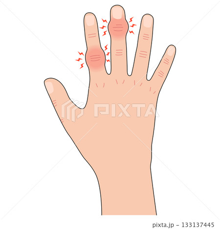 へバーデン結節とブシャール結節 へバーデン結節とブシャール結節 133137445