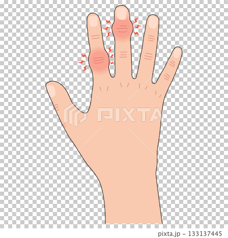 赫伯登節點和布沙爾節點 赫伯登節點和布沙爾節點 133137445