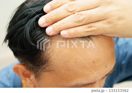 Bald head in man, hair loss treatment health problem. Bald head in man, hair loss treatment health problem. 133153562