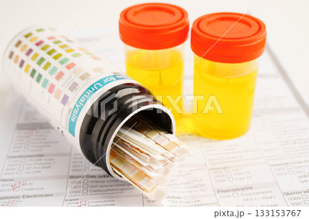 Urinalysis, urine cup with reagent strip pH paper test and comparison chart in laboratory. Urinalysis, urine cup with reagent strip pH paper test and comparison chart in laboratory. 133153767
