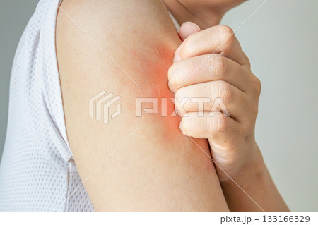 Young asian man itching and scratching on arm from allergic itchy dry skin eczema dermatitis insect bites 133166329