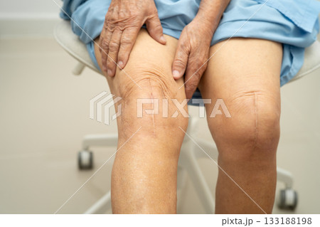 Asian elderly woman patient with scar knee replacement surgery in hospital. Asian elderly woman patient with scar knee replacement surgery in hospital. 133188198