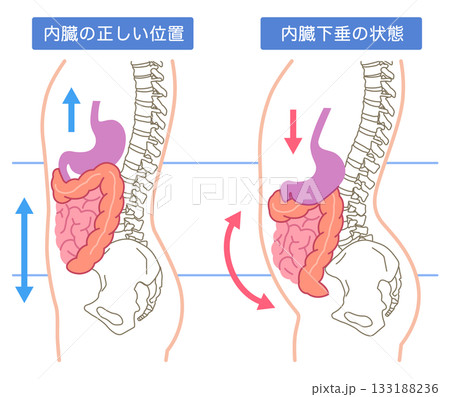 内臓下垂　内臓の位置が下がっている状態 133188236