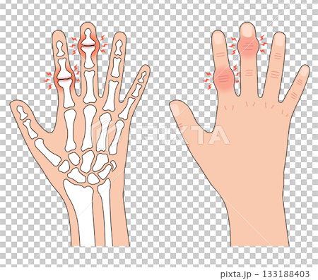 赫伯登節點和布沙爾節點 赫伯登節點和布沙爾節點 133188403