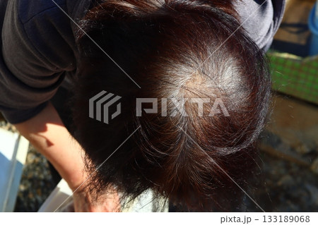 50代女性のつむじ薄毛と白髪のクローズアップ|頭皮・毛根・エイジングヘア素材 50代女性のつむじ薄毛と白髪のクローズアップ|頭皮・毛根・エイジングヘア素材 133189068