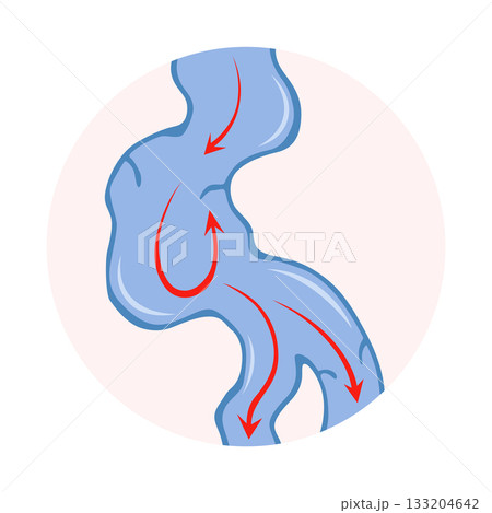 Varicose veins. Blue blood vessel visible through the skin. Vascular disease diagnostic and treatment. Venous insufficiency medical 133204642