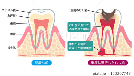 健康な歯と進行したむし歯 歯の内部構造 健康な歯と進行したむし歯 歯の内部構造 133207748