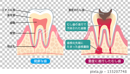 健康な歯と進行したむし歯 歯の内部構造 健康な歯と進行したむし歯 歯の内部構造 133207748