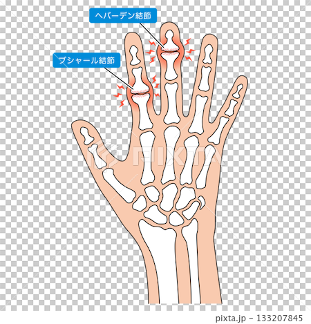 赫伯登節點和布沙爾節點 赫伯登節點和布沙爾節點 133207845