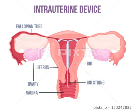 Lud. Intrauterine device placement in uterus, female contraception birth control copper or hormonal coil mirena iucd medical education preventive pregnancy neat vector illustration 133242883