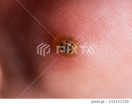 Detailed Image Of Verruca On A Human Toe. An Extreme Close-Up Highlights The Skin Texture And Wart. Detailed Image Of Verruca On A Human Toe. An Extreme Close-Up Highlights The Skin Texture And Wart. 133251720