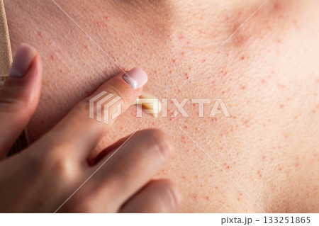 Medicinal anti-inflammatory cream for eliminating rashes and pimples on the skin of the body, close-up Medicinal anti-inflammatory cream for eliminating rashes and pimples on the skin of the body, close-up 133251865