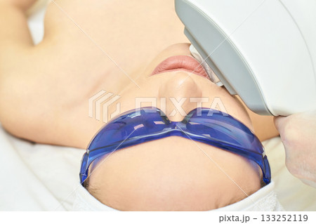Caucasian female receiving laser treatment wearing protective eyewear at spa Caucasian female receiving laser treatment wearing protective eyewear at spa 133252119