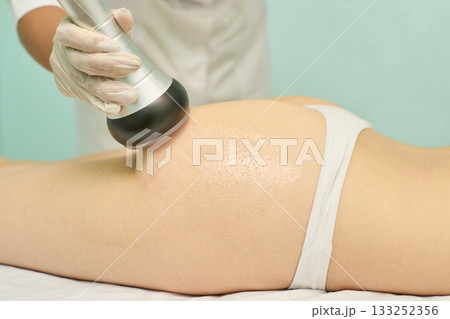 Caucasian female receiving cellulite treatment with ultrasonic cavitation Caucasian female receiving cellulite treatment with ultrasonic cavitation 133252356