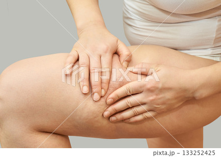 Female caucasian adult examining cellulite on thigh with hands in close-up view 133252425
