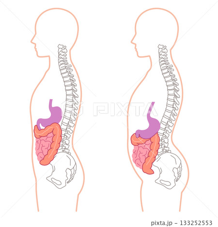 内臓下垂　内臓の位置が下がっている状態 133252553
