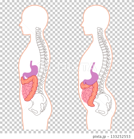 内臓下垂　内臓の位置が下がっている状態 133252553