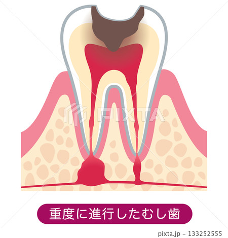 むし歯が進行し、歯の根にある神経に膿がたまった歯の断面図 根管治療 むし歯が進行し、歯の根にある神経に膿がたまった歯の断面図 根管治療 133252555