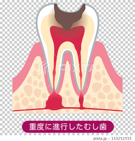 むし歯が進行し、歯の根にある神経に膿がたまった歯の断面図 根管治療 むし歯が進行し、歯の根にある神経に膿がたまった歯の断面図 根管治療 133252555
