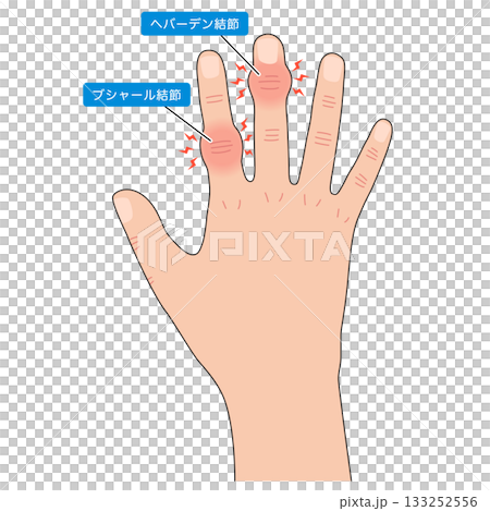 赫伯登節點和布沙爾節點 赫伯登節點和布沙爾節點 133252556