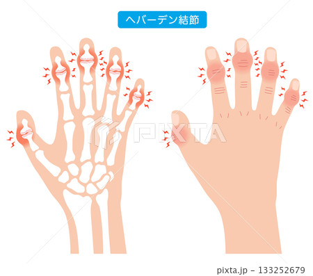 へバーデン結節 指の関節の病気 へバーデン結節 指の関節の病気 133252679