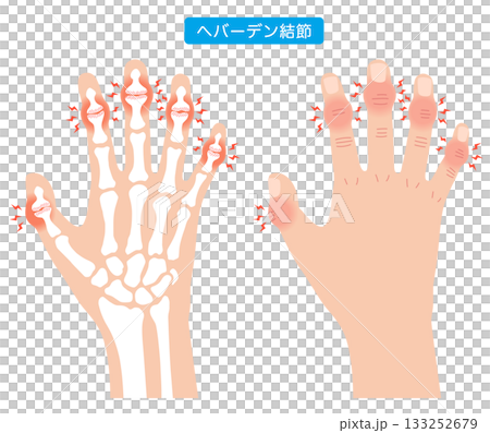 赫伯登結節:一種手指關節疾病 赫伯登結節:一種手指關節疾病 133252679