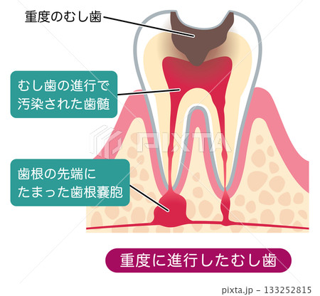 むし歯が進行し、歯の根にある神経に膿がたまった歯の断面図 根管治療 むし歯が進行し、歯の根にある神経に膿がたまった歯の断面図 根管治療 133252815