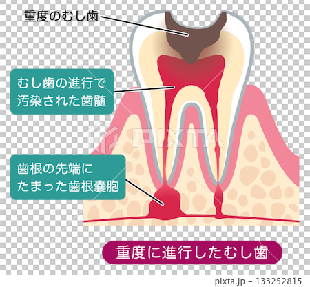むし歯が進行し、歯の根にある神経に膿がたまった歯の断面図 根管治療 むし歯が進行し、歯の根にある神経に膿がたまった歯の断面図 根管治療 133252815