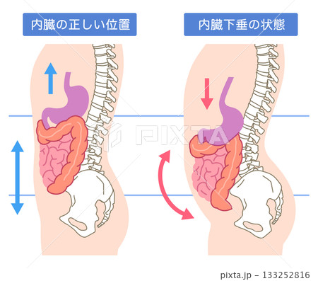 内臓下垂　内臓の位置が下がっている状態 133252816