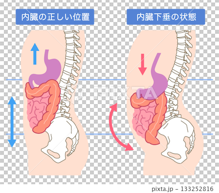 内臓下垂　内臓の位置が下がっている状態 133252816