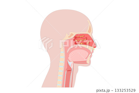Allergic rhinitis poster Allergic rhinitis poster 133253529