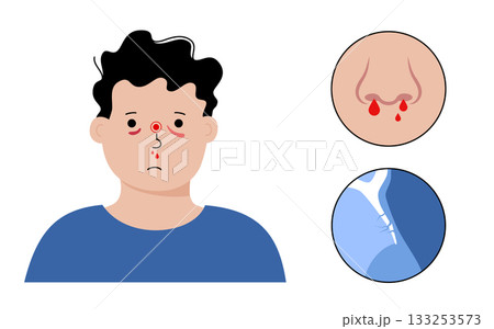Nasal fracture poster 133253573