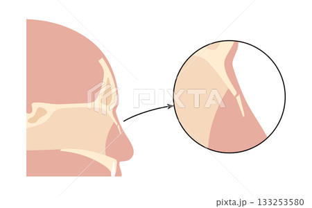 Nasal fracture poster 133253580
