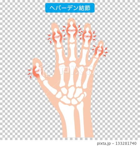 赫伯登結節:一種手指關節疾病 赫伯登結節:一種手指關節疾病 133281740